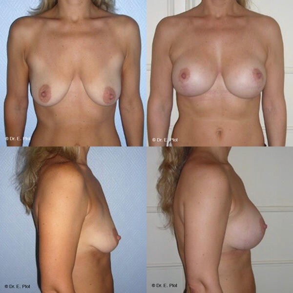 Exemples d'augmentation mammaire - photos avant-après